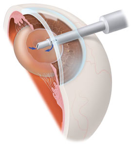 graphic of phacoemulsification removing cataract